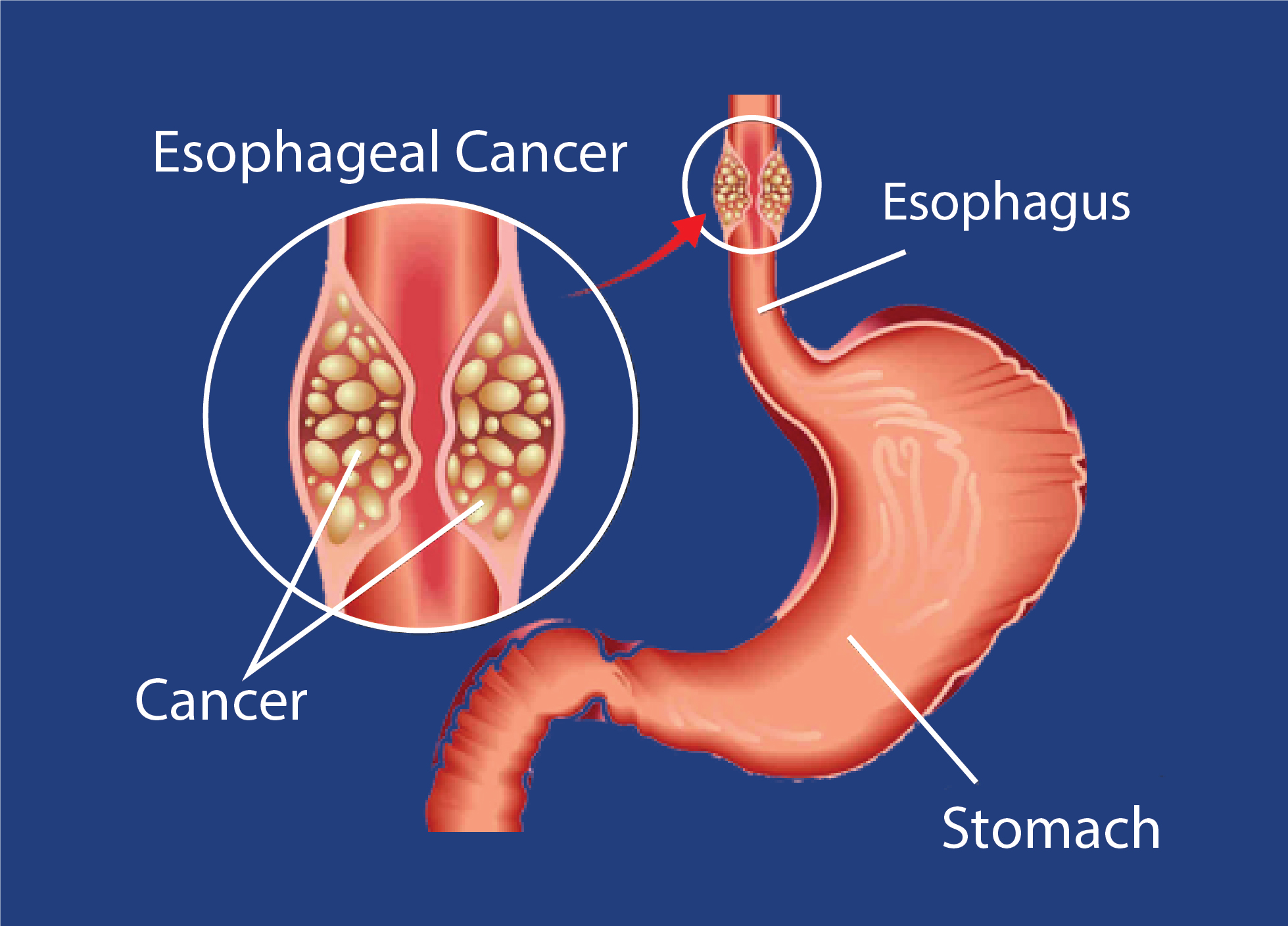 Esophagus Cancer Diagram Esophagus Cancer Diagram